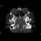 Chordoma: CT - Computed tomography