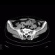 Chronic inflammatory changes of terminal ileum and rectum, pelvic lipomatosis: CT - Computed tomography