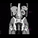 Chronic inflammatory changes of terminal ileum and rectum, pelvic lipomatosis: CT - Computed tomography