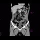 Chronic inflammatory changes of terminal ileum and rectum, pelvic lipomatosis: CT - Computed tomography