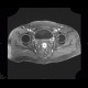 Chronic inflammatory changes of terminal ileum and rectum, pelvic lipomatosis: MRI - Magnetic Resonance Imaging