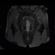 Chronic inflammatory changes of terminal ileum and rectum, pelvic lipomatosis: MRI - Magnetic Resonance Imaging