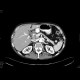 Chronic calcified pancreatitis: CT - Computed tomography