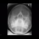 Chronic sinusitis, Waters view: X-ray - Plain radiograph