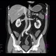 Chronic inflammatory changes of neoterminal ileum: CT - Computed tomography