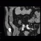 Chronic inflammatory changes of neoterminal ileum, CPR: CT - Computed tomography