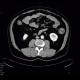 Chronic inflammatory changes of neoterminal ileum: CT - Computed tomography