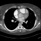 Chronic lung embolism, pulmonary hypertension, webs, adherent thrombi: CT - Computed tomography