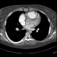 Chronic lung embolism, pulmonary hypertension, webs, adherent thrombi: CT - Computed tomography