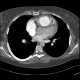 Chronic lung embolism, pulmonary hypertension, webs, adherent thrombi: CT - Computed tomography