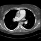 Chronic lung embolism, pulmonary hypertension, webs, adherent thrombi: CT - Computed tomography