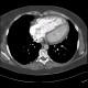 Chronic lung embolism, pulmonary hypertension, webs, adherent thrombi: CT - Computed tomography