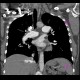 Chronic lung embolism, pulmonary hypertension, webs, adherent thrombi: CT - Computed tomography