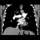 Chronic lung embolism: CT - Computed tomography