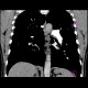 Chronic lung embolism: CT - Computed tomography