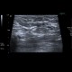 Chronic lymph node, lymph node, chronic: US - Ultrasound
