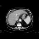 Liver cirrhosis: CT - Computed tomography