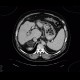 Myelolipoma of adrenal gland, liver cirrhosis, portal vein thrombosis: CT - Computed tomography