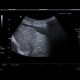 Liver cirrhosis: US - Ultrasound