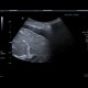 Liver cirrhosis: US - Ultrasound