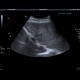 Liver cirrhosis: US - Ultrasound