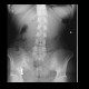 Foreign body, cecum: X-ray - Plain radiograph