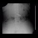 Foreign body in the gut, bowel: X-ray - Plain radiograph