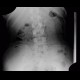 Foreign body in the gut, bowel: X-ray - Plain radiograph