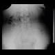 Foreign body in the gut, bowel: X-ray - Plain radiograph