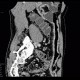 Crohn's  disease, cobble stone: CT - Computed tomography