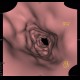 Crohn's  disease, cobble stone, virtual endoscopy: CT - Computed tomography