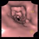 Crohn's  disease, cobble stone, virtual endoscopy: CT - Computed tomography