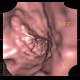 Crohn's  disease, cobble stone, virtual endoscopy: CT - Computed tomography