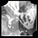 Crohn's  disease, cobble stone, enteroclysis: RF - Fluoroscopy