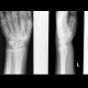 Colles fracture: X-ray - Plain radiograph