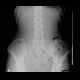 Colonic transit time, transit time, delayed, day one: RF - Fluoroscopy