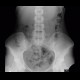 Colonic transit time, transit time, delayed, day four: RF - Fluoroscopy