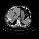 Liver metastasis of colorectal cancer, RFA: CT - Computed tomography