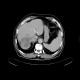 Liver metastasis of colorectal cancer, RFA: CT - Computed tomography