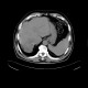 Liver metastasis of colorectal cancer, RFA: CT - Computed tomography