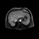 Liver metastasis of colorectal cancer, RFA: MRI - Magnetic Resonance Imaging