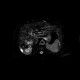 Liver metastasis of colorectal cancer, RFA: MRI - Magnetic Resonance Imaging