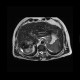 Liver metastasis of colorectal cancer, RFA: MRI - Magnetic Resonance Imaging