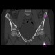 Fracture of pelvis - iliac bone and acetabulum: CT - Computed tomography