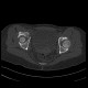 Fracture of pelvis - iliac bone and acetabulum: CT - Computed tomography