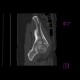 Fracture of pelvis - iliac bone and acetabulum: CT - Computed tomography