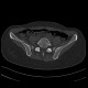Fracture of pelvis - iliac bone and acetabulum: CT - Computed tomography