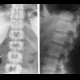Compression fracture of lumbar vertebra: X-ray - Plain radiograph