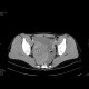 Corpus luteum cyst: CT - Computed tomography