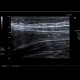 Crohn's disease of terminal ileum: US - Ultrasound